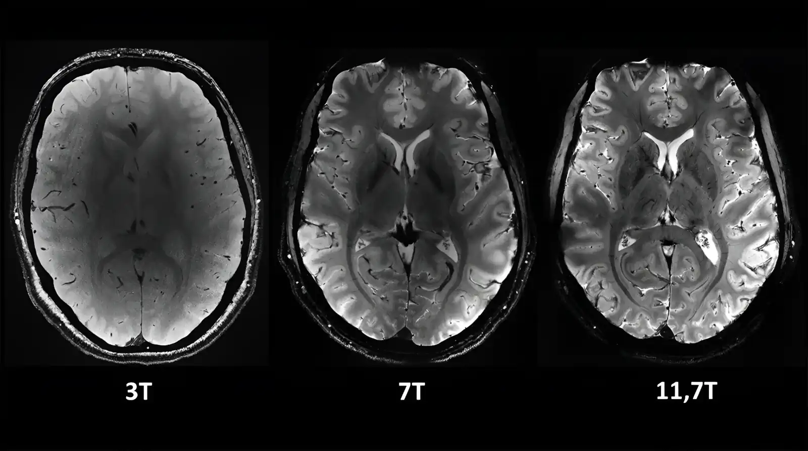 L'IRM la plus puissante au monde, Iseult, capture les premières images sans précédent du cerveau humain